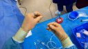 Varicocoel embolisation with spirale coils